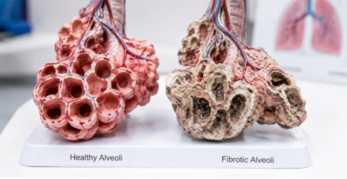 hbot for pulmonary fibrosis