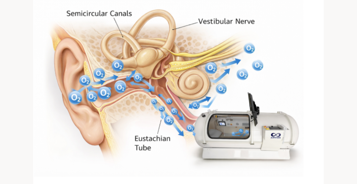 hyperbaric chamber for vertigo